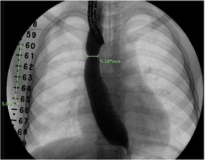 Initial Esophageal Anastomosis Diameter Predicts Treatment Outcomes in Esophageal Atresia Patients With a High Risk for Stricture Development